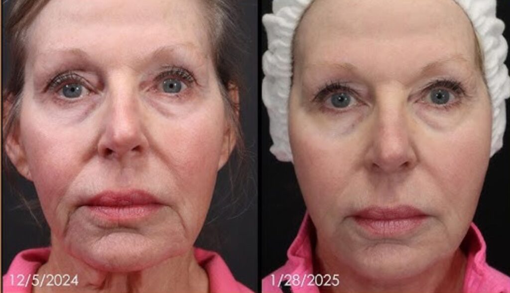 Before and after results of a patient treated with radiofrequency skin tightening (RF skin tightening), noticeable reduction in fine lines, improved skin texture, and firmer facial contours after non-invasive RF treatment.