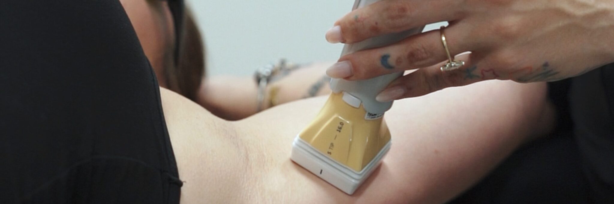Client receiving Motus AY laser hair removal at Prime MD for smooth, elegant results.