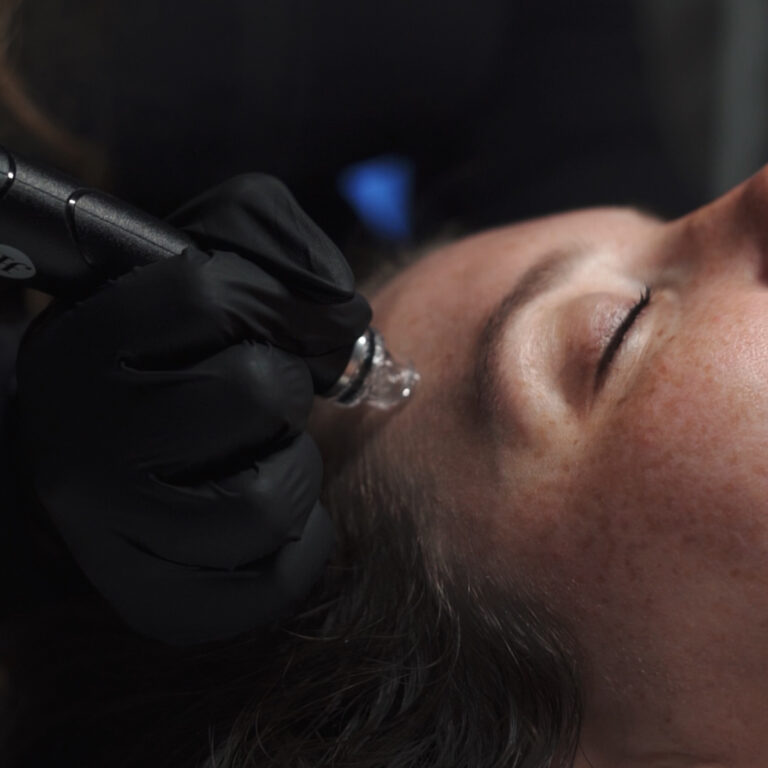 Patient receiving VirtueRF microneedling treatment at Prime MD Aesthetics & Wellness for skin tightening and rejuvenation.