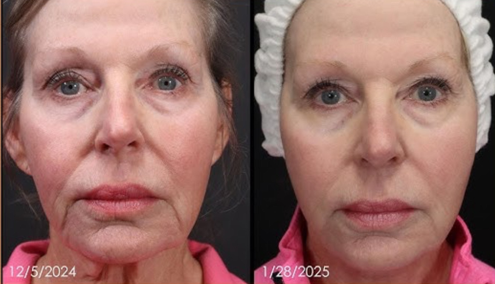 Before and after results of a patient treated with radiofrequency skin tightening (RF skin tightening), noticeable reduction in fine lines, improved skin texture, and firmer facial contours after non-invasive RF treatment.