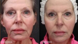Before and after results of a patient treated with radiofrequency skin tightening (RF skin tightening), noticeable reduction in fine lines, improved skin texture, and firmer facial contours after non-invasive RF treatment.